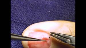 glomus tumor symptoms in fingers nails