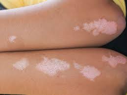 white spots on skin causes treatment