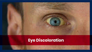causes and types of eye discoloration