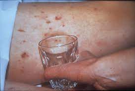 Reasons for excessive sweating stop sweating best deodorant for sweat rash around mouth baby rash on face how do you stop face treatment. What Is The Meningitis Rash Meningitis Research Foundation