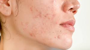 how to get rid of acne scars topical