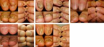 clinical study of twenty nail dystrophy