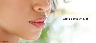 white spots on lips symptoms causes