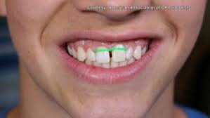 Can you get straighter teeth without braces? On Your Side Orthodontists Call Diy Braces A Dangerous Trend Wgme