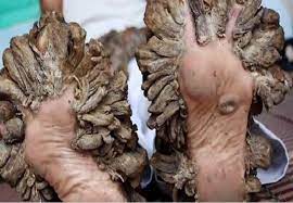 It is characterized by abnormal susceptibility to human papillomaviruses (hpvs) of the skin. The Tree Man Syndrome Wtf