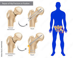 stockilratie repair of hip fracture