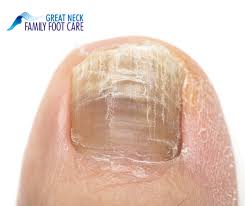 identifying fungal nails great neck
