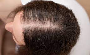 hair loss and ibd ibdrelief