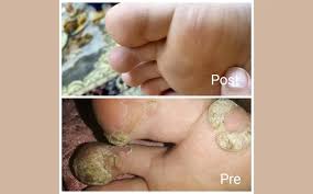 warts treatment in hurghada book now