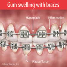 gum swelling can happen with braces
