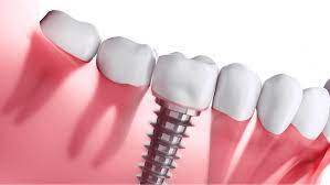 how much do dental implants cost a