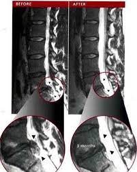 two thirds of herniated discs resolve