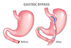 bariatric surgery at affordable cost in