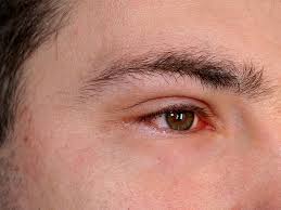 Blurred vision is a common symptom of glaucoma. Inflammation Of The Eye Symptoms Causes And Treatment