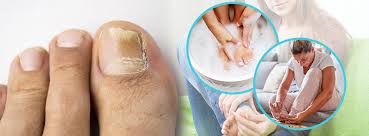 treat toenail fungus