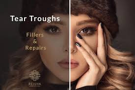 tear trough fillers and repairs get