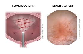 intersial cysis bladder pain