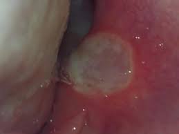 Many conditions may cause a swollen roof of the mouth, including sores, dehydration, and mucus buildups. Red Spots On Roof Of Mouth Causes And Other Symptoms