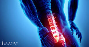 spinal stenosis what it is and how we
