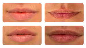 fuller lips laser lip plumping