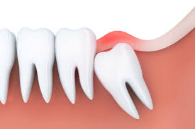 top 3 causes of wisdom tooth removal