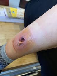 Boy Is Left With Inch Deep Hole In His Leg And On An Iv Drip