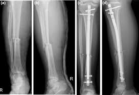 tibial shaft fractures