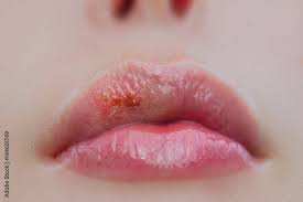 herpes virus on sick female lips