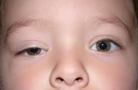 droopy eyelids ptosis pediatric