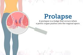 prolapse symptoms causes treatment