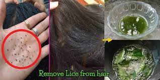 anti dandruff anti lice oil do it