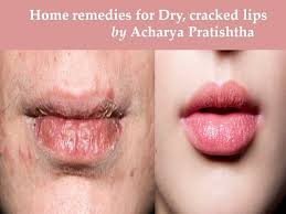 home remes for ed lips dry