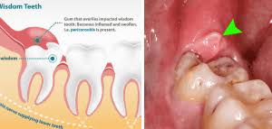 wisdom tooth pain cause cure