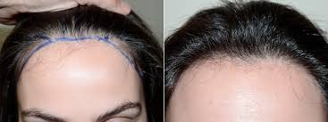 Learn from hairsite's top ranked faculty surgeons. Hair Transplants For Women Photos Foundation For Hair Restoration