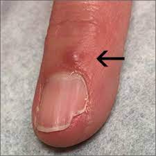 fingernail deformity mdedge family