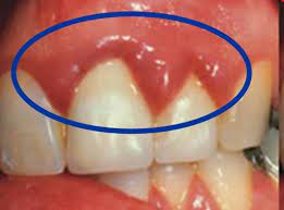 natural cure for swollen gums