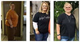 400 pounds lost gastric byp before
