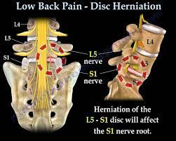 low back pain disc herniation