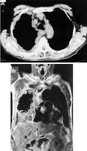 The other primary differences between asbestosis and mesothelioma are: A 71 Year Old Patient With Pleural Mesothelioma Ct Scan Top A Download Scientific Diagram