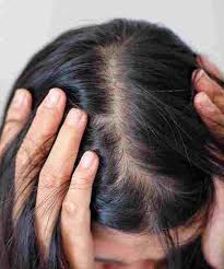 what hormones cause hair loss in