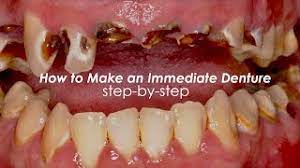 how to make an imate denture step