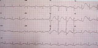 hypokalemia and hyperkalemia acls com