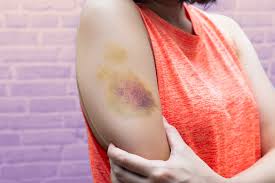 bruising easily causes risks treatment