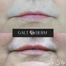 botox lip flip in fort lauderdale fl