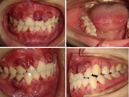 multiple gingival pregnancy tumors with