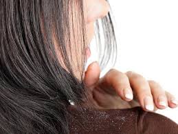 onion juice for dandruff removal
