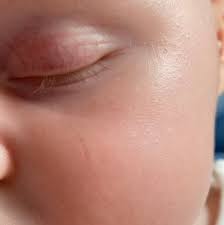 baby scratched scarred face mumsnet