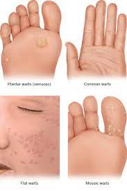 what are the symptoms of warts storymd