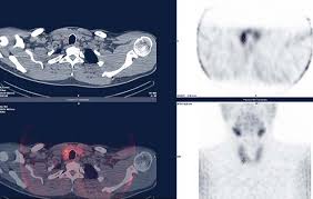 Imaging of thyroid dysfunction is safe and clinically relevant in children. Scintigraphie Des Parathyroides Medecine Nucleaire Atlantique