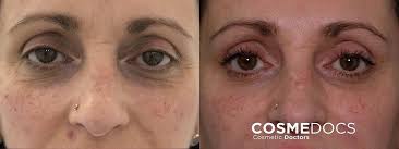 baby botox before and after photos and